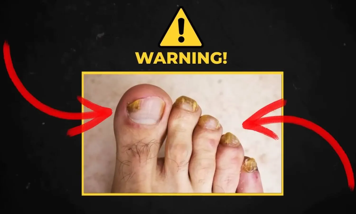 Warning about nail fungus
